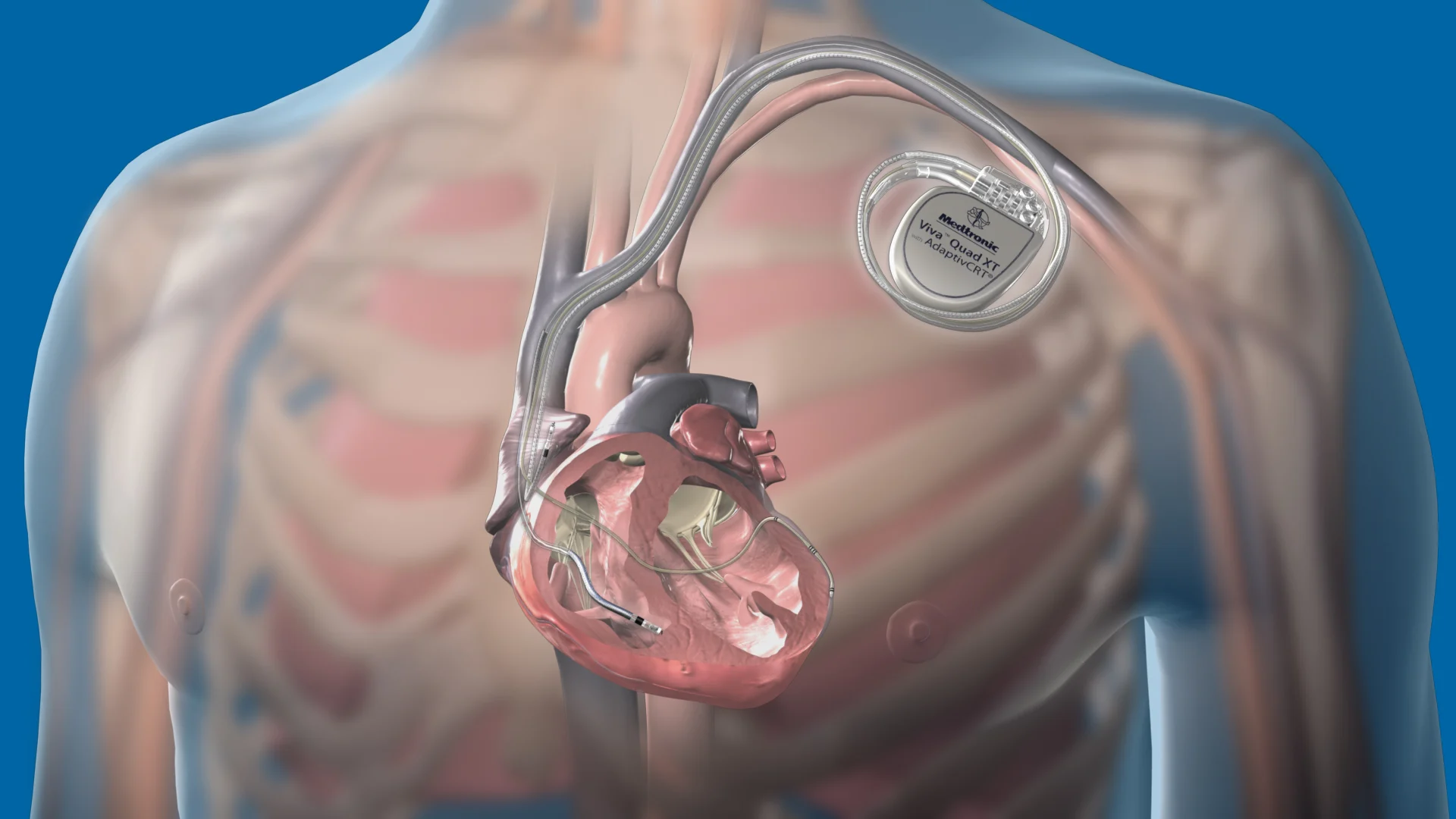 ICD / CRTD Implants