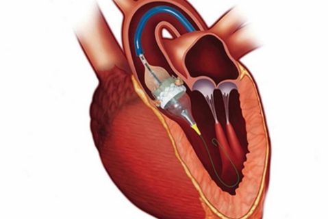 TAVI / TAVR Surgery