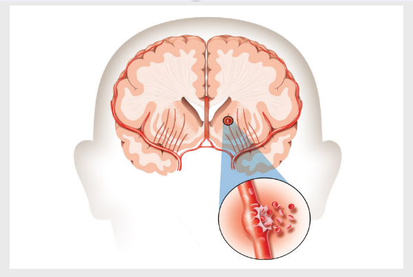 Brain Hemorrhage - An Emergency Condition