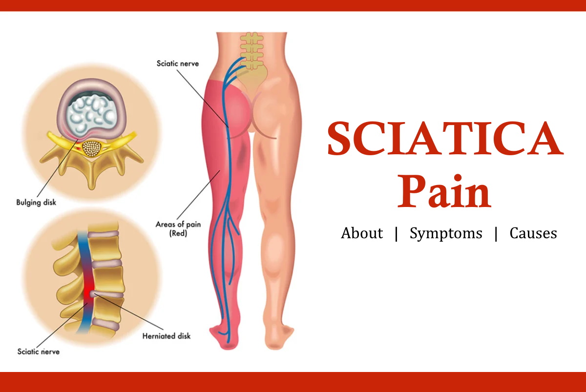 What are the causes of Sciatica?