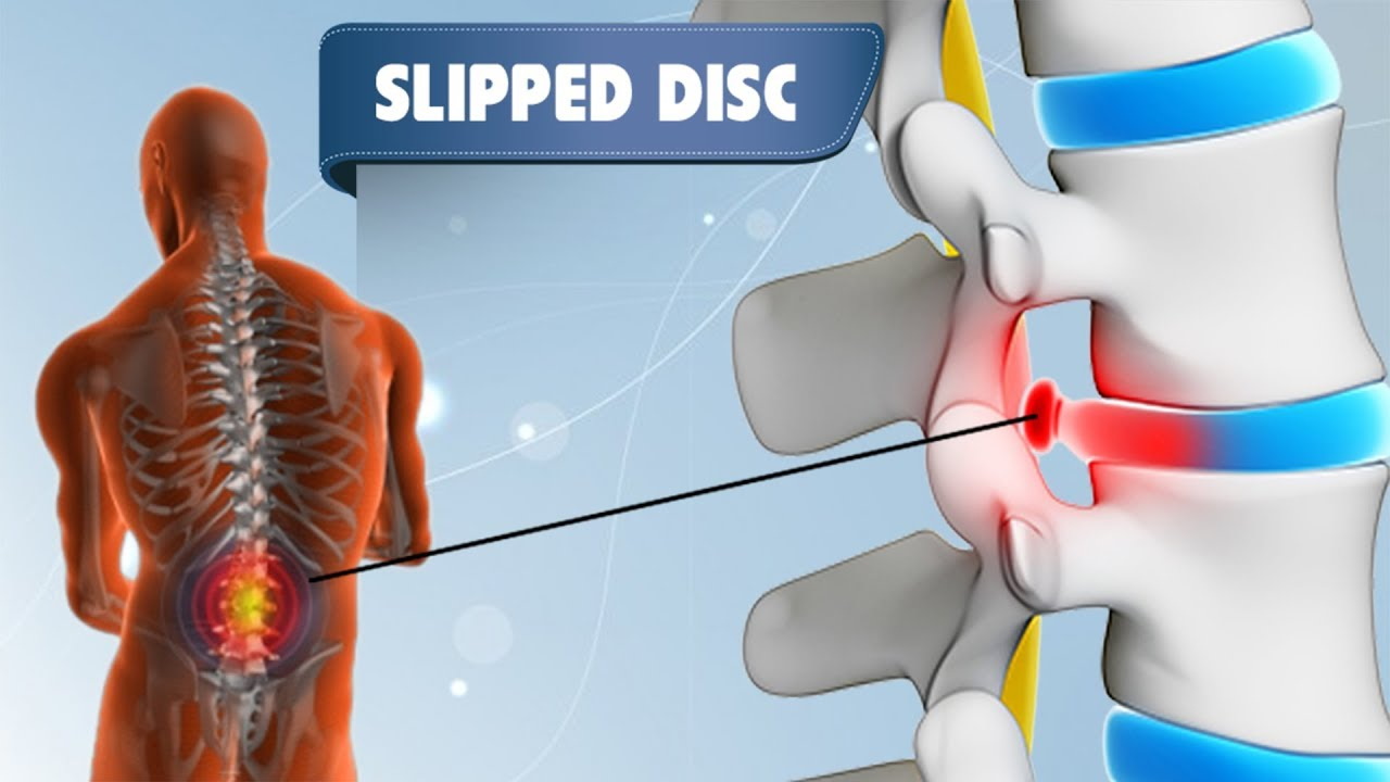 What is Slip Disc? Symptoms of Slip Disc